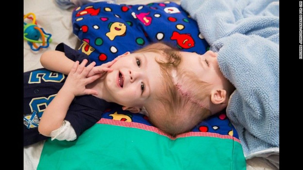EtatsUnis des jumeaux siamois séparés après plus de 16 heures d