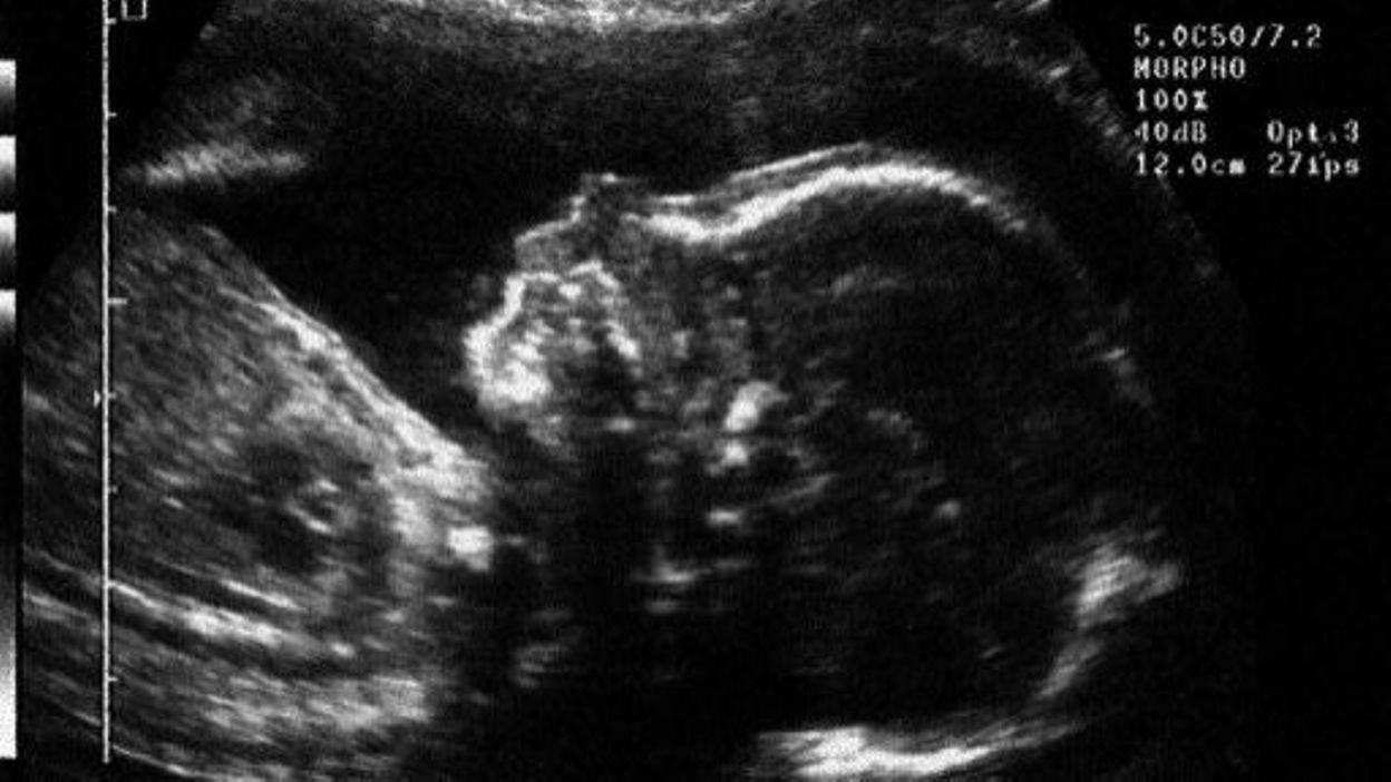Signe Que Le Coeur Du Bébé Ne Bat Plus USA: un Etat interdit tout avortement quand le coeur du foetus bat