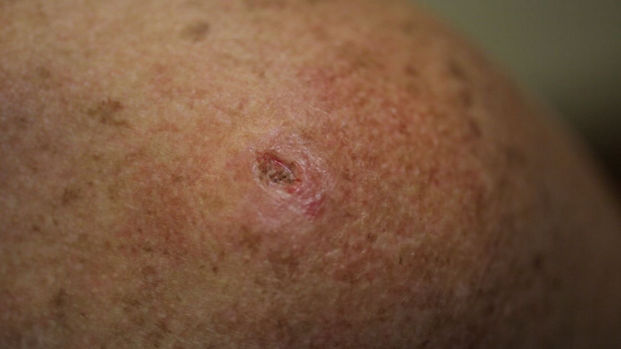 A Scab A Wound That Does Not Heal Consult Your Dermatologist Or Your