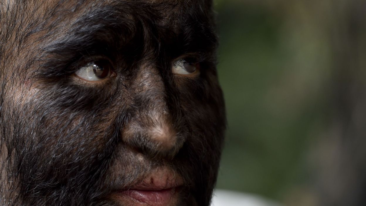 Espagne Un Medicament Mal Etiquete Provoque Le Syndrome Du Loup Garou Chez Des Enfants Espagne Un Medicament Mal Etiquete Provoque Le Syndrome Du Loup Garou Chez Des Enfants