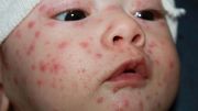 Épidémie de varicelle en France: faut-il s'inquiéter à la veille d'un départ en vacances? Épidémie de varicelle en France: faut-il s'inquiéter à la veille d'un départ en vacances?