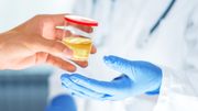 Vers la piste de tests d'urine pour dépister les cancers Vers la piste de tests d'urine pour dépister les cancers