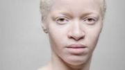 Afrique de l'Est : les albinos sont victimes de persécution et de sorcellerie Afrique de l'Est : les albinos sont victimes de persécution et de sorcellerie