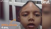 Une petite fille de 4 ans reçoit une greffe du crâne en Inde Une petite fille de 4 ans reçoit une greffe du crâne en Inde
