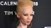 Thando Hopa, modèle sud-africaine, fut la première albinos à figurer en couverture de "Vogue". Thando Hopa, modèle sud-africaine, fut la première albinos à figurer en couverture de "Vogue".