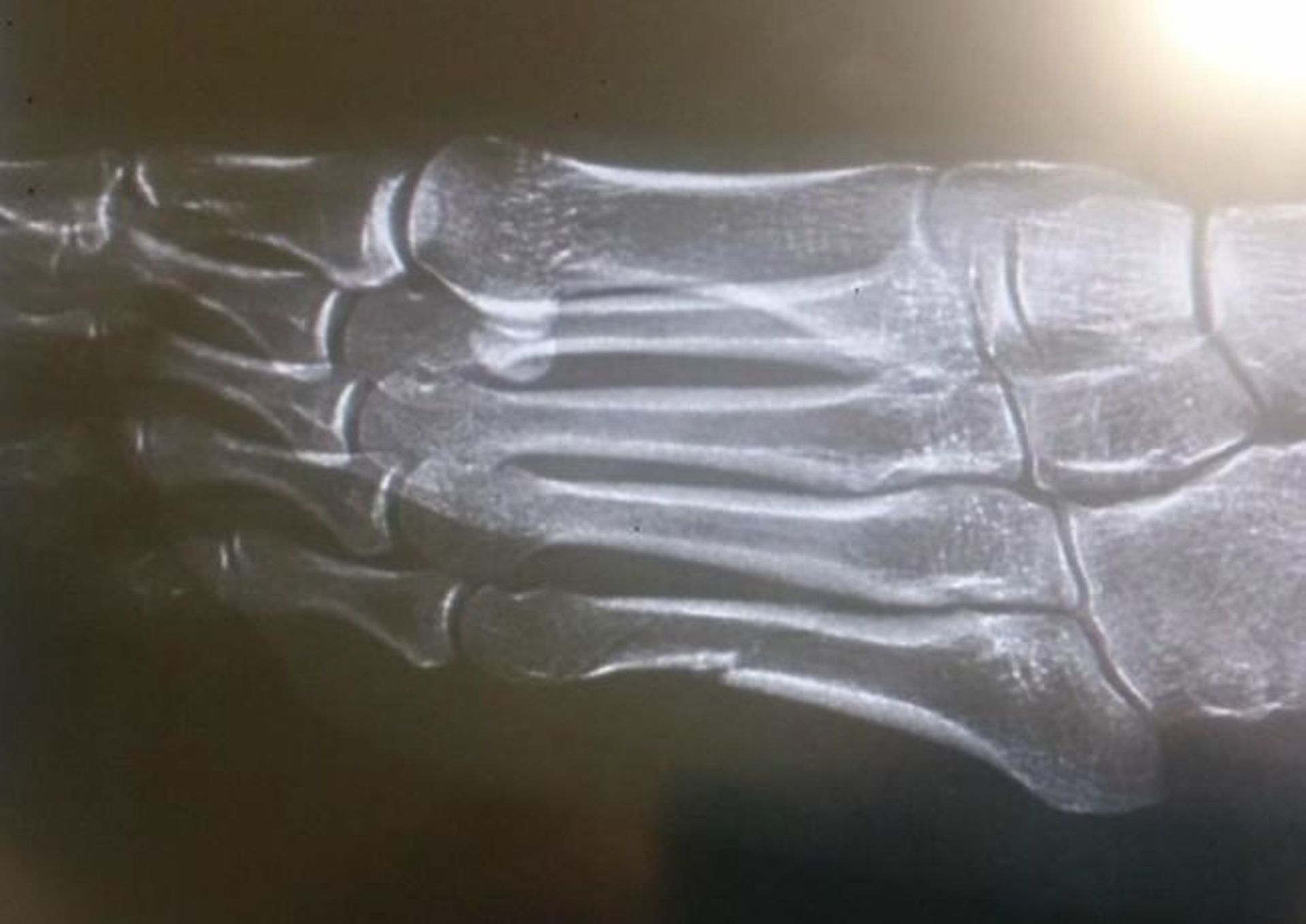 La Polonaise Kowalczyk publie une radio de son pied fracturé