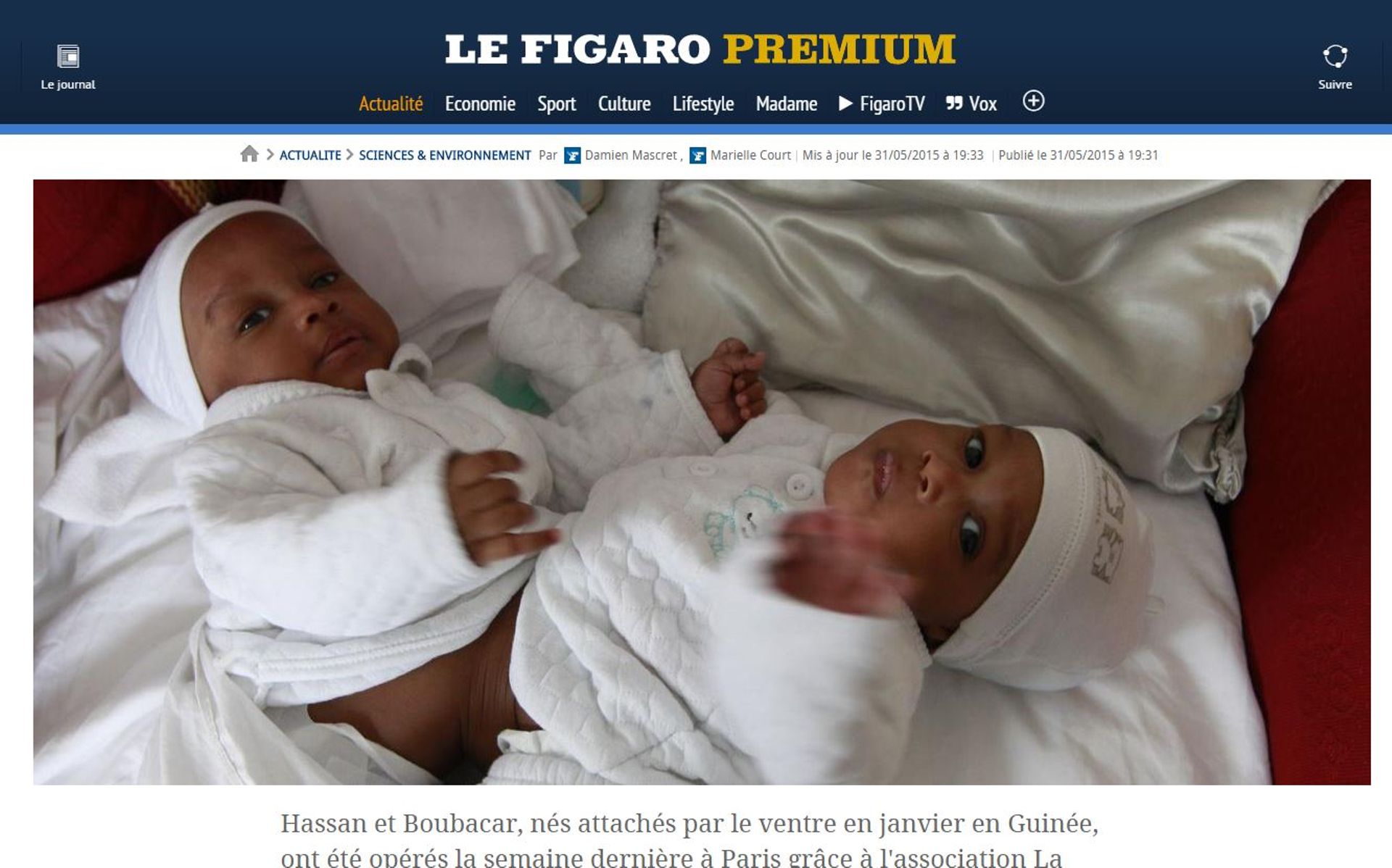 Deux Bebes Siamois Separes A Paris Un Veritable Exploit Chirurgical