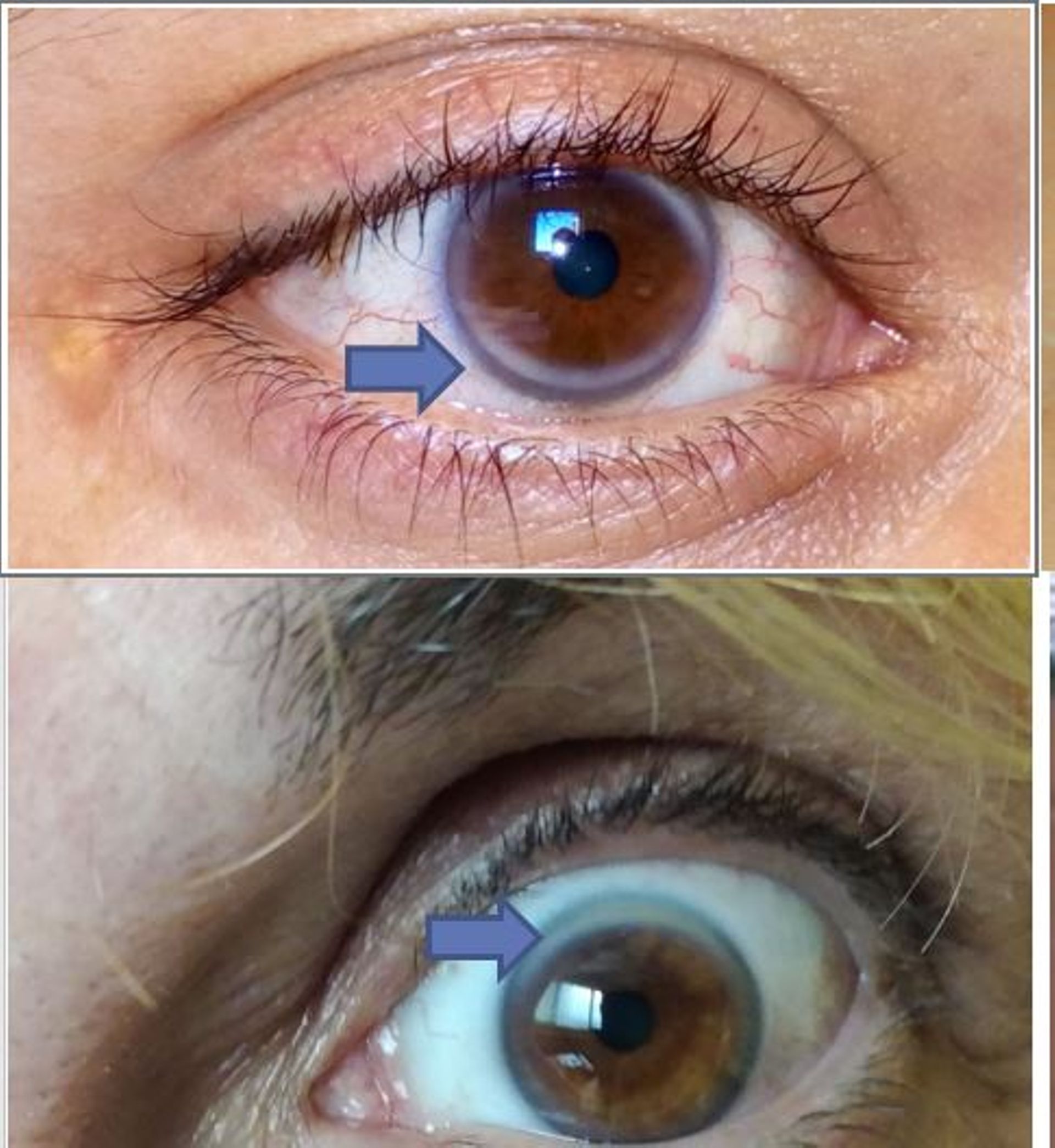 Quand l’excès de cholestérol est une affaire de famille