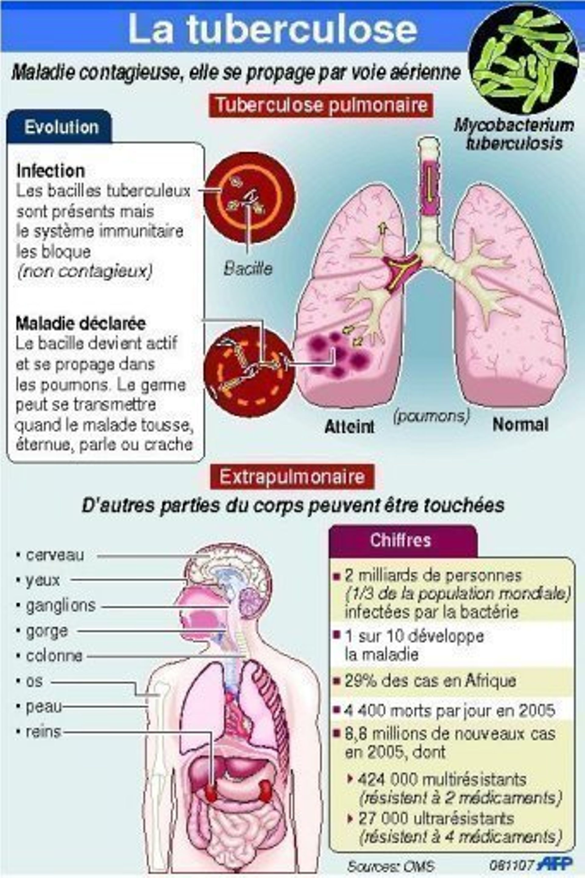 Tuberculose résistante carences du dépistage en SeineStDenis