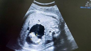 Colombie Un Bebe Nait Avec Le Fœtus De Sa Sœur Jumelle Dans Son Ventre