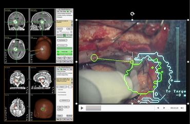 Vue du microscope du chirurgien avec de la réalité augmentée. En vert, les contours de la malformation à réséquer et en blanc la projection d'une zone moteur à laquelle il ne faut impérativement pas toucher. Vue du microscope du chirurgien avec de la réalité augmentée. En vert, les contours de la malformation à réséquer et en blanc la projection d'une zone moteur à laquelle il ne faut impérativement pas toucher.