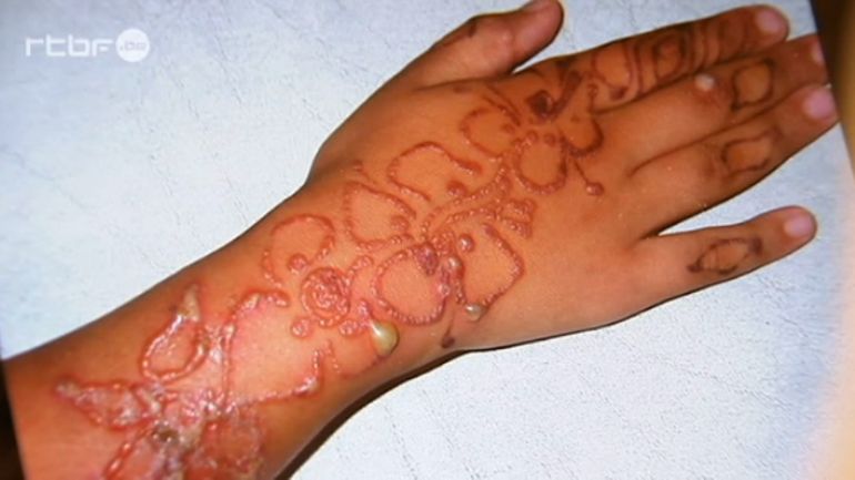 Focus tatouage éphémère au henné, gare au risque d'allergie cutanée