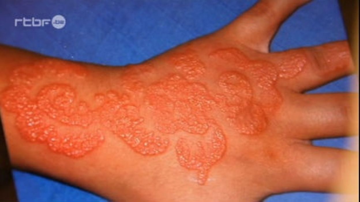 Tatouage au henné : gare aux allergies !