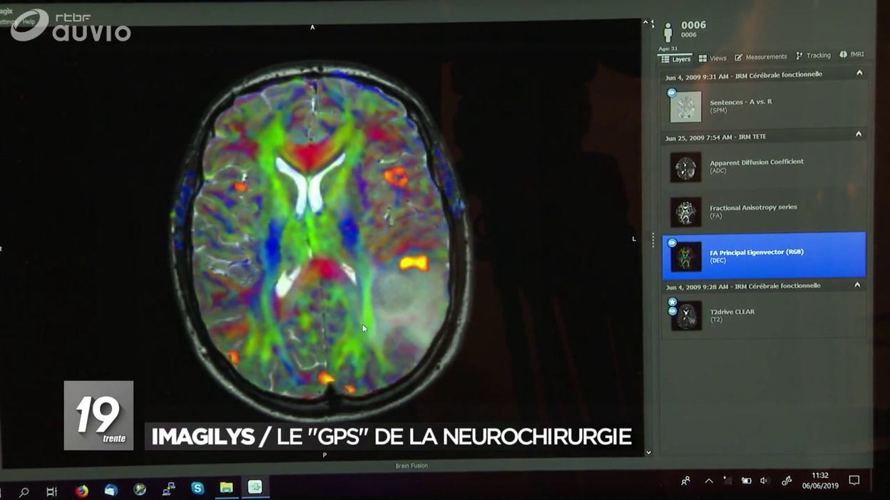Imagilys : le GPS de la neurochirurgie