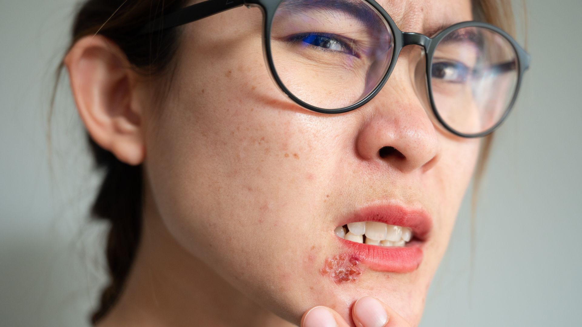 La perlèche, tout sur cette inflammation au niveau des lèvres - La ...