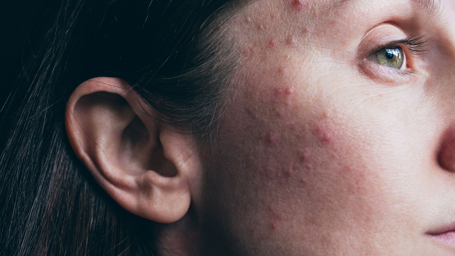 L'acné vulgaire : quand consulter ?